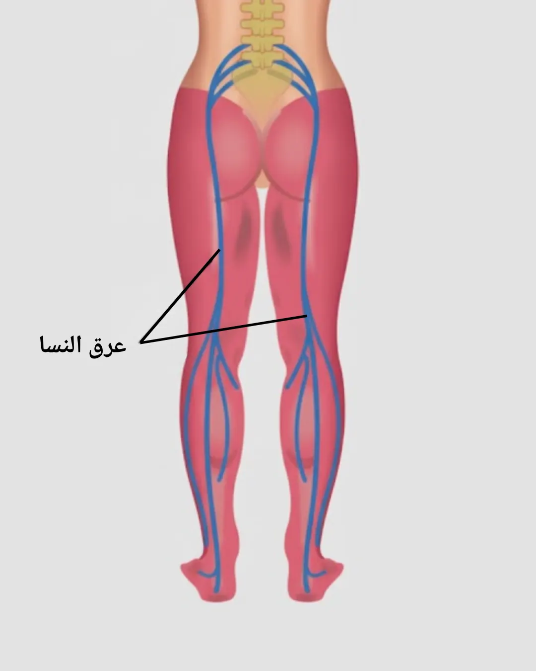 عرق النسا